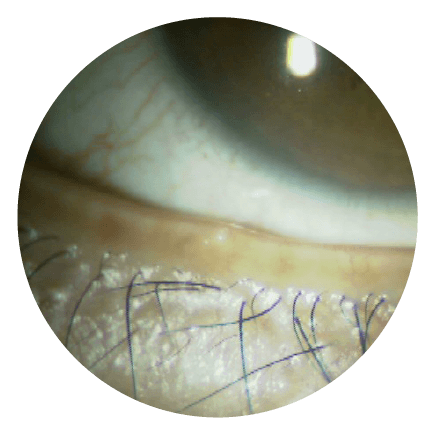 マイボーム腺圧出前の下眼瞼