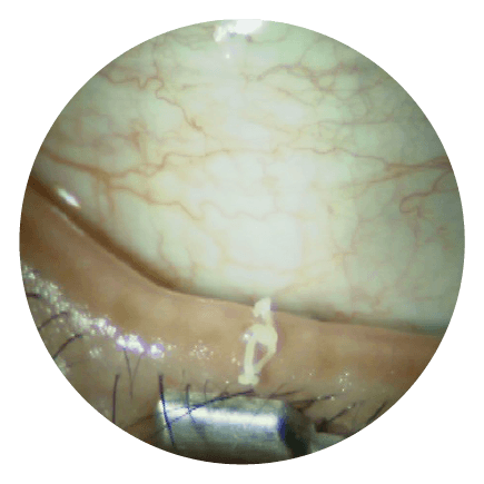 マイボーム腺から圧出された汚れた脂分